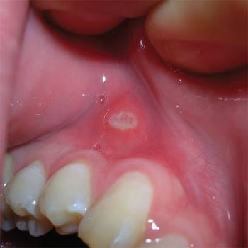 blemmer på munnslimhinnen