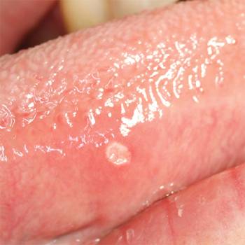 blemmer på munnslimhinnen